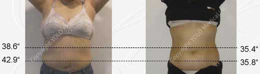Before and After Hair Removal Photos