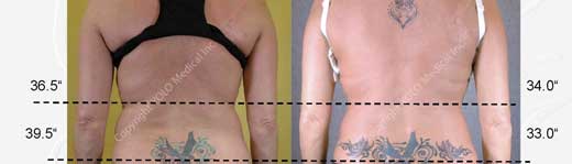 Before and After Hair Removal Photos
