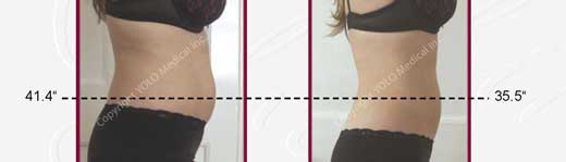 Before and After Hair Removal Photos